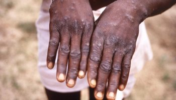Texas confirms the first case of Monkeypox