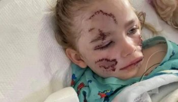 A pit bull in South Carolina attacked the girl and her mother, leaving her with horrific facial scars