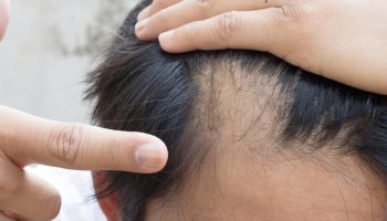 Alopecia causes severe hair loss; to treat hair loss first drug was introduced!