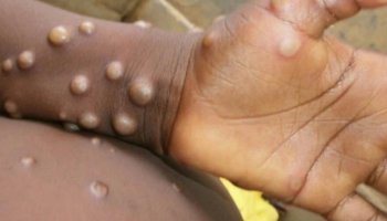 Is Monkeypox called an STD? How does it spread?