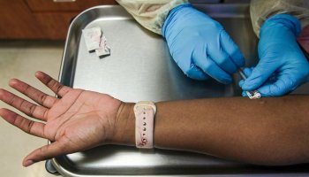 We shouldn't tiptoe around monkeypox risk