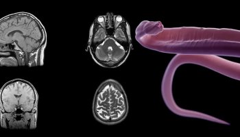 Oh My God! Worm Found In Woman’s Brain!